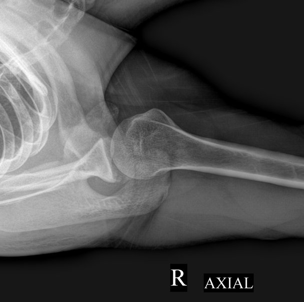 Figure 3 for case Bennett lesion
